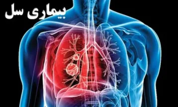 شناسایی سالیانه حدود 80 بیمار مبتلا به سل درنیشابور